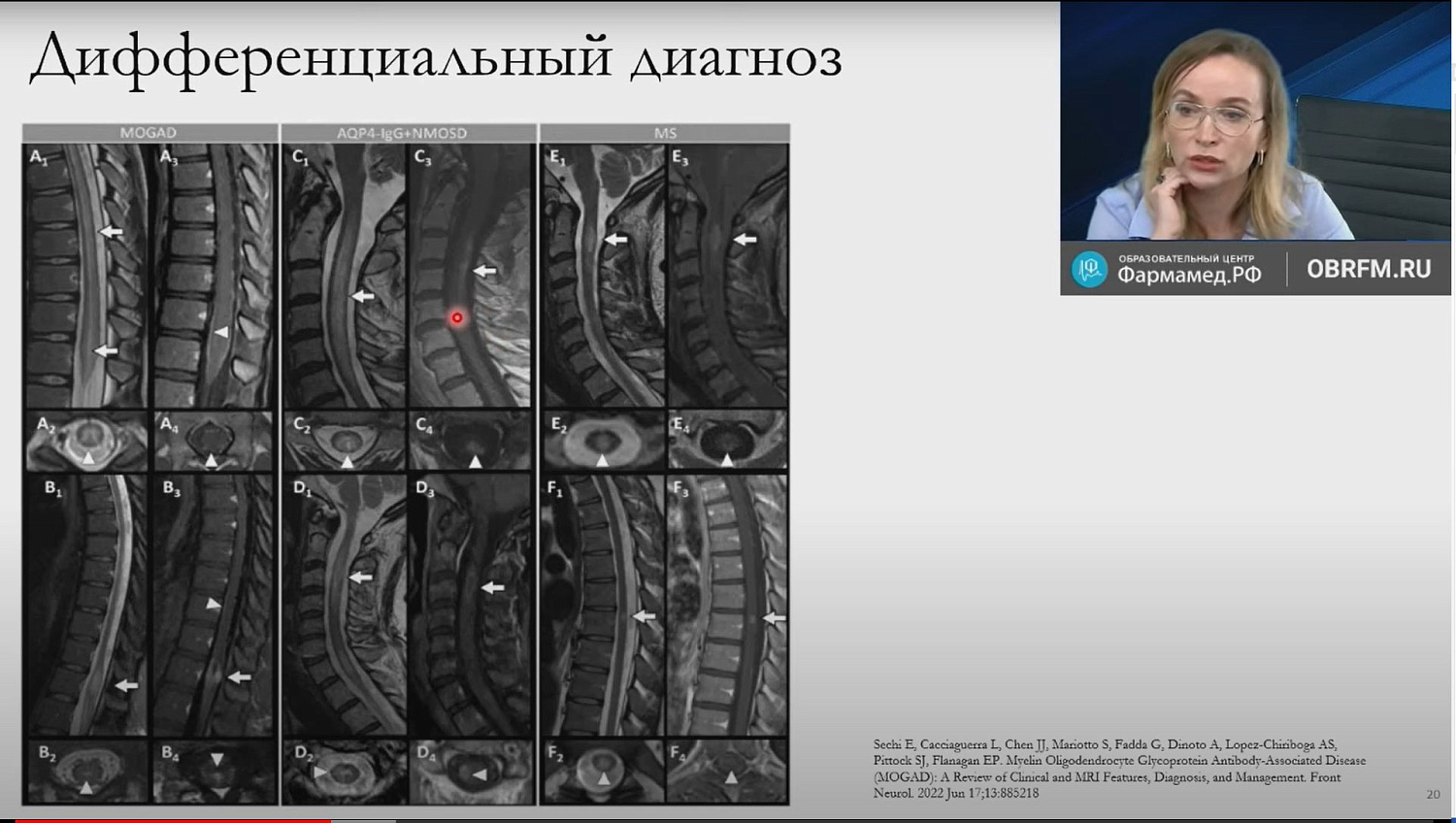 Лекция «Лучевая диагностика миелопатий»